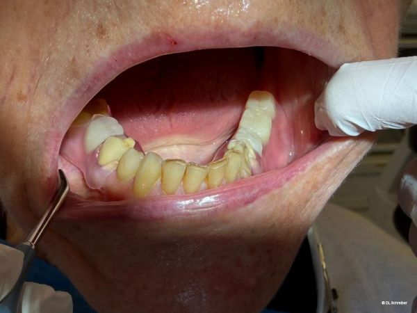 KeySplint Soft Pink im Patientenmund